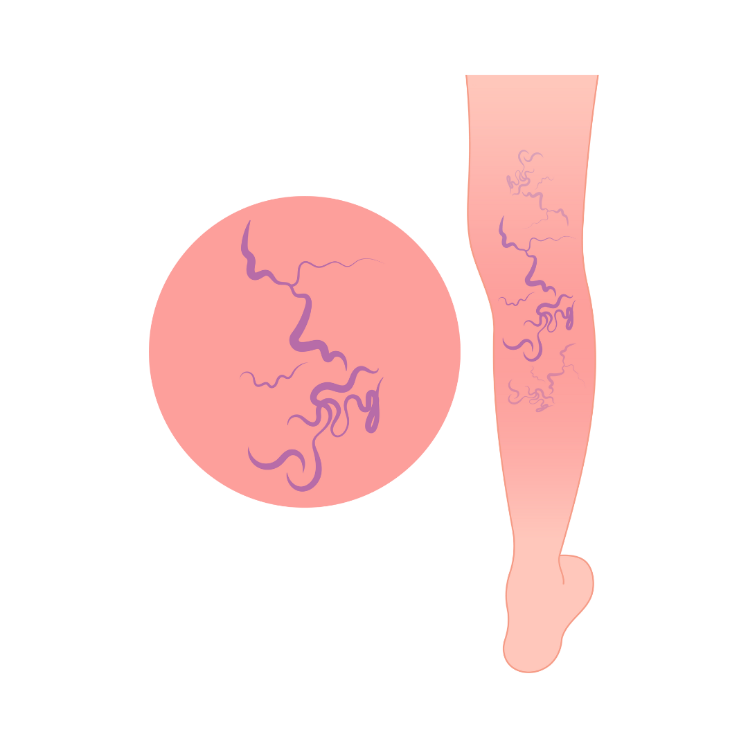 Varicose Veins Texas Cardiac & Vascular Institute