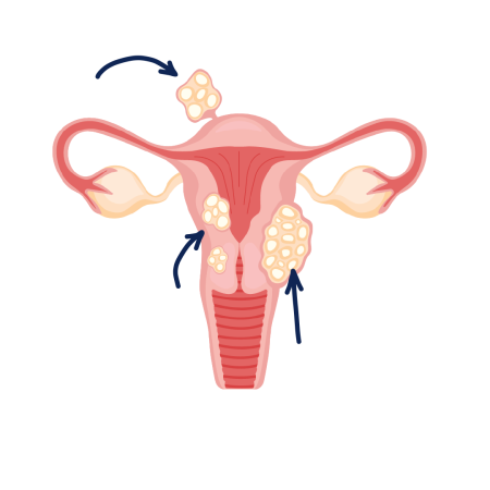 Uterine Fibroid