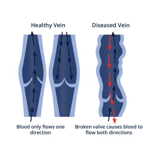 Venous Insufficiency