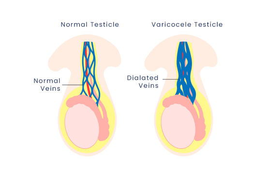 varicocele